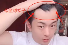 压力太大？辛巴直播暴露发量，头发稀少疑似“秃顶”图片