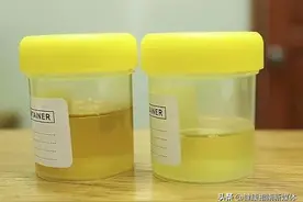 如何识别蛋白尿图片