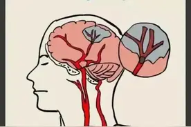 治疗缺血性脑卒中，有哪些安全有效的中成药？（口服篇）图片