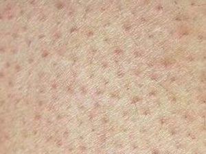 民间治疗毛孔角化症