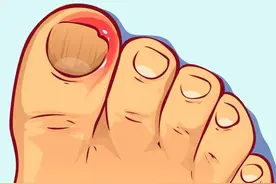 甲沟炎，问题不算大，伤害性极强！遇到这个疾病该咋办？请看此文图片