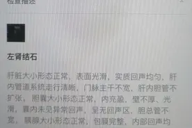 肾结石，正在慢慢溶解……图片