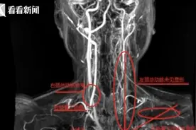24岁女子得相思病险半身不遂 血管似70岁老人图片