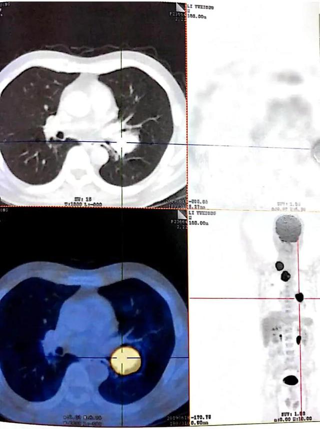 中央型肺癌非角化