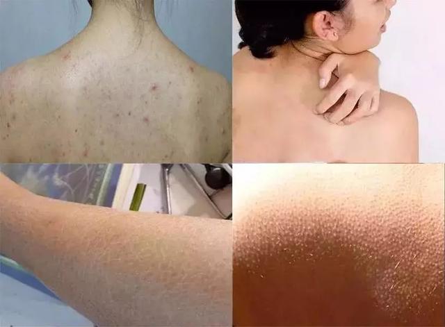 太阳晒伤可以用身体乳擦吗