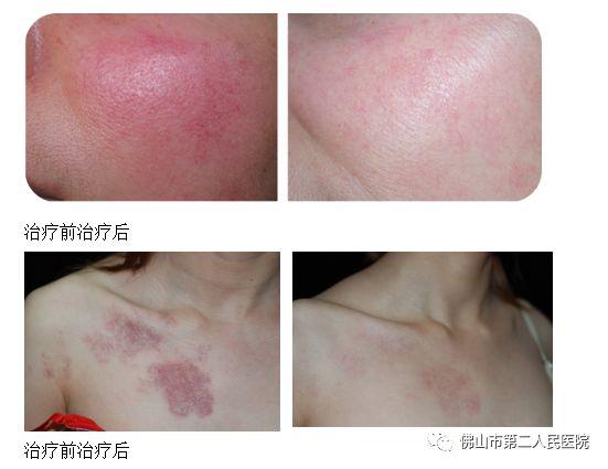 脂溢性角化激光价钱