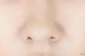 鼻子上挤出白色颗粒？闻起来有点臭，医生告诉你怎样去除图片