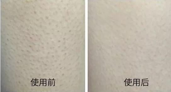 鸡皮肤霜一天抹几次