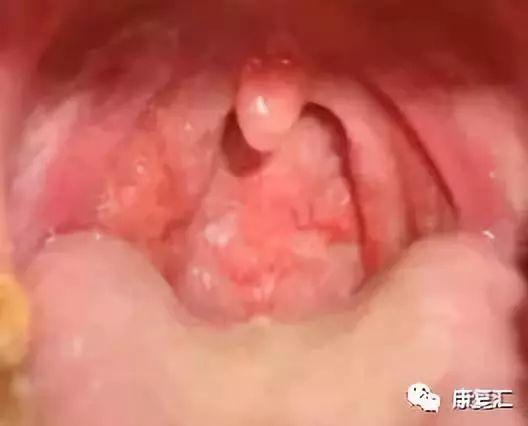 皮肤病手掌心角化裂隙能否对肌瘫瘫肌力鉴定