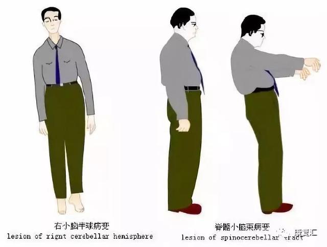 皮肤病手掌心角化裂隙能否对肌瘫瘫肌力鉴定
