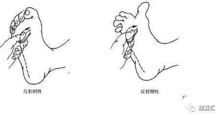 皮肤病手掌心角化裂隙能否对肌瘫瘫肌力鉴定