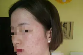 花19元祛痘却背上“美容贷”：涉事机构不具医疗资质，金融平台或涉嫌违规放贷图片