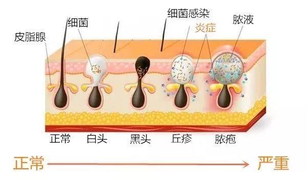 青春期皮肤角化