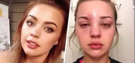 青春期皮肤角化