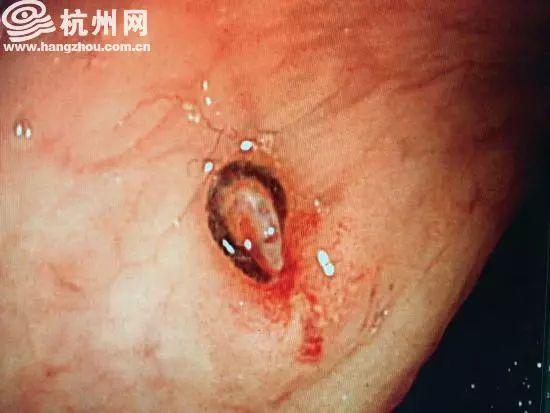 肚子痛拉屎起鸡皮疙瘩