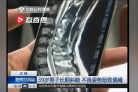吓哭！每天歪在沙发上玩手机，男子脊髓只剩一条线！差点偏瘫……视频封面