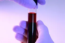 如何正确解读血检报告中的PSA值？