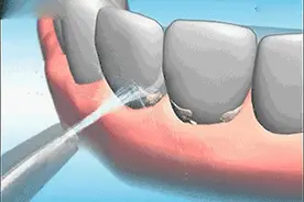 不洗牙，你永远不知道牙龈下面多脏！图片