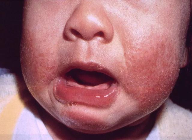 宝宝湿疹反反复复？都因为这几点没做对……