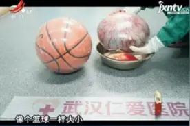 湖北武汉：女子肚大孕妇 竟是7.6斤巨大卵巢肿瘤视频封面