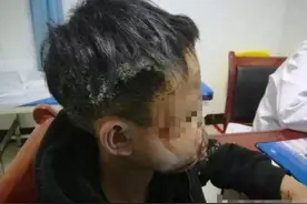 13岁少年燃放鞭炮，遇哑炮意外爆炸面目全非图片
