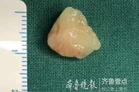 山东19岁小伙胸部反复闷痛，竟是心尖上长了个肿瘤！图片