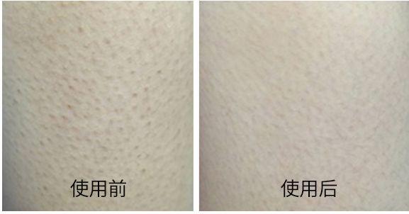 屁股上毛孔角化