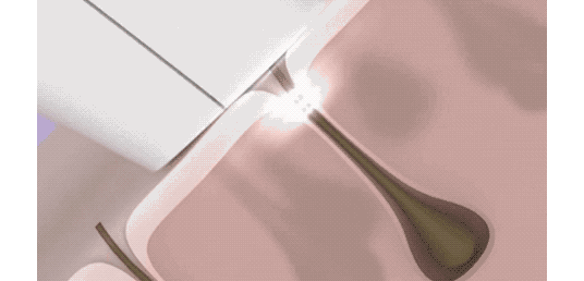 毛周角化能用家用冰点脱毛仪器吗