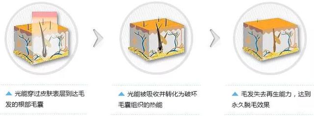 毛囊角化病可以用脱毛膏吗