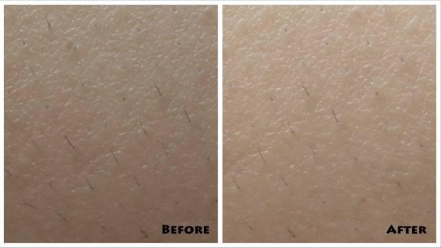 毛周角化能用家用冰点脱毛仪器吗