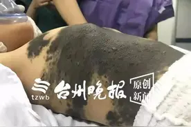 可怜！3岁娃得怪病身上长满“兽皮”，千里寻医到台州图片