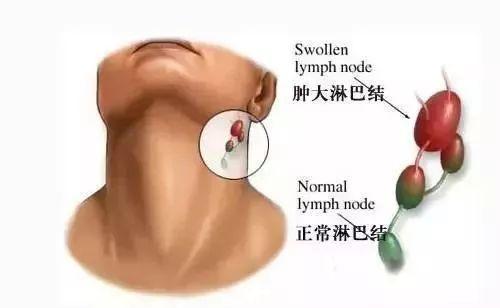 非角化鳞状细胞癌咽喉有什么症状