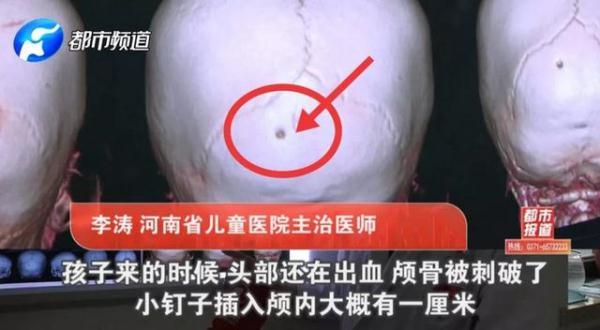 玩具成凶器！1岁孩子头颅被刺穿！这些伤人玩具你家可能也有