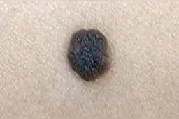 痣你知道多少？图片