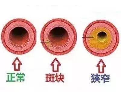 【提醒】颈动脉，人体最怕堵的血管！50%中风都跟它有关