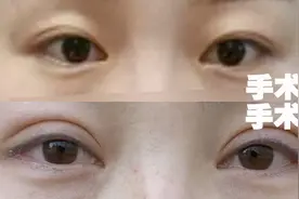 女子双眼皮割得比眼睛还宽，整形医院：确实割宽了，化妆遮遮吧视频封面