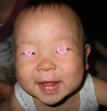 幼儿小腿起小鸡皮疙瘩