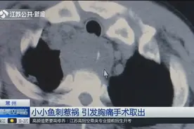 小小鱼刺惹祸端，男子不小心吞下导致感染引发胸痛，医生手术取出视频封面
