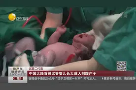中国大陆首例试管婴儿长大成人剖腹产子视频封面