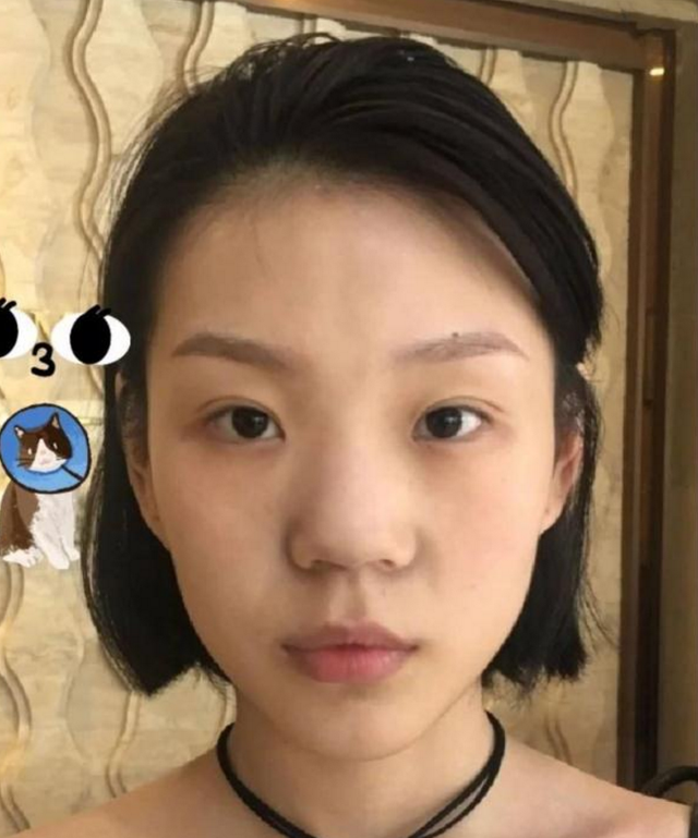 什么是肋软骨隆鼻?（想要做成高级脸）