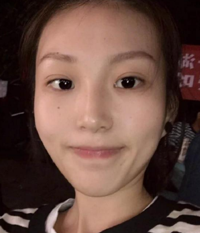 想要做成高级脸，鼻综合：肋软骨隆鼻