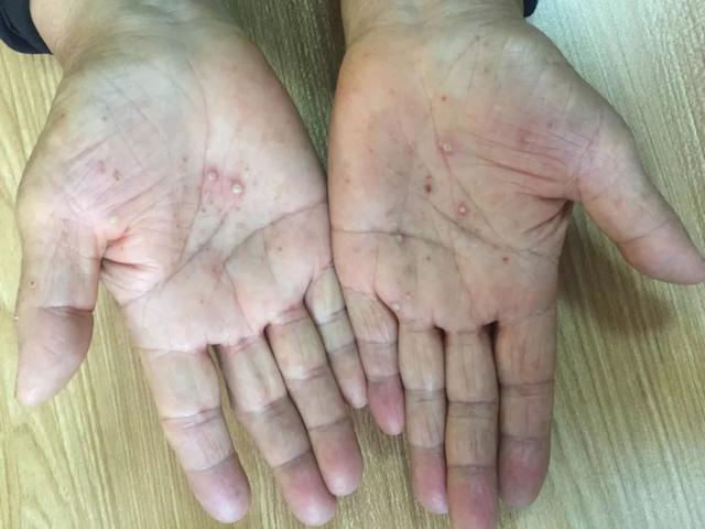 掌跖角化病百度百科