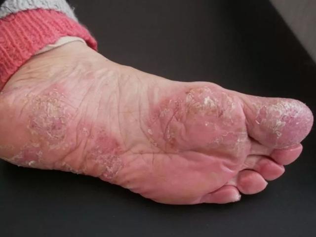 掌跖角化病百度百科