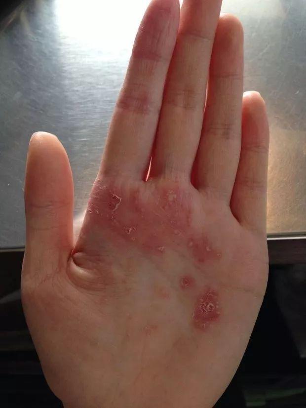 掌跖角化病百度百科