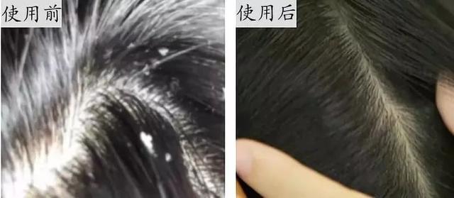 鐢ㄥ畠娲椾竴娆″ご锛屼竴鍛ㄥ悗涓嶈劚澶村彂浜嗭紝涓濈桓鑸煍婊戯紝涓€姊冲埌搴? onerror=