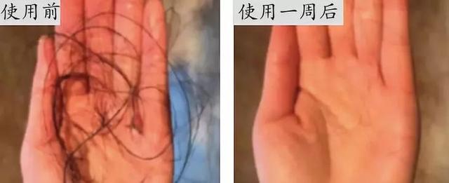 鐢ㄥ畠娲椾竴娆″ご锛屼竴鍛ㄥ悗涓嶈劚澶村彂浜嗭紝涓濈桓鑸煍婊戯紝涓€姊冲埌搴? onerror=