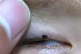 【提醒】2岁娃眼皮上突然冒出小黑点！医生：这东西会要命！图片