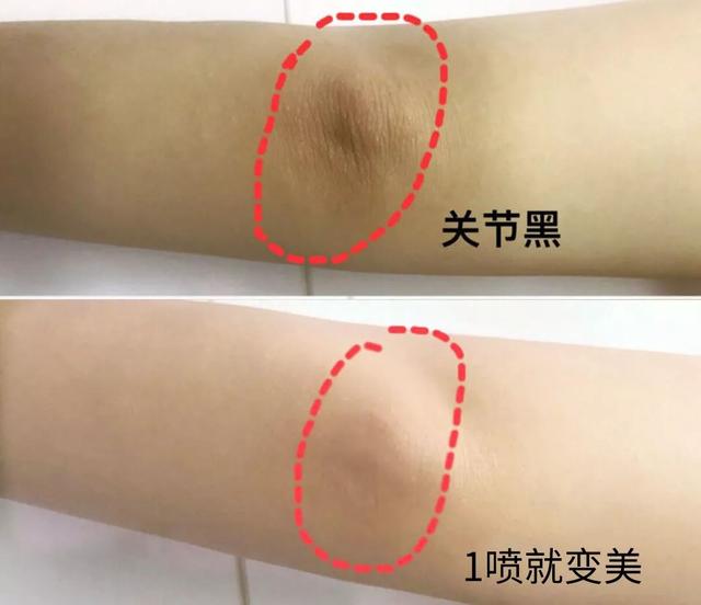 丝袜可以遮鸡皮肤吗