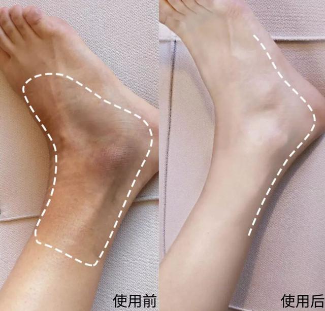 丝袜可以遮鸡皮肤吗