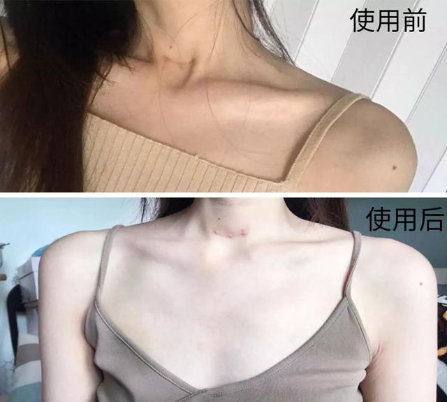 丝袜可以遮鸡皮肤吗
